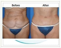 Slider image (5) Aesthetic Cosmetic Plastic Surgery Center Bolivia - SensualBodyDream